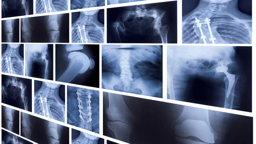 simmons spine injuries blog image
